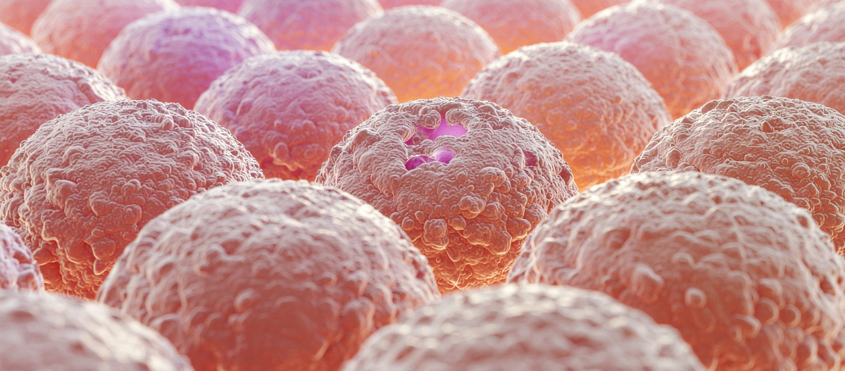 Stark vergrößerte, schematische Darstellung von Hautkrebszellen mit unregelmäßiger Oberfläche und sichtbaren Zellkernen.